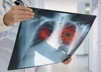 Health Ministry launching pilot to detect early-stage lung cancer