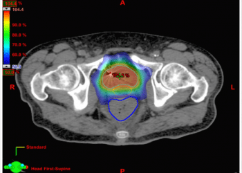 Can a balloon protect prostate cancer patients during radiation treatment?  